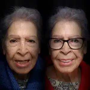 all-on-x-before-after (12)