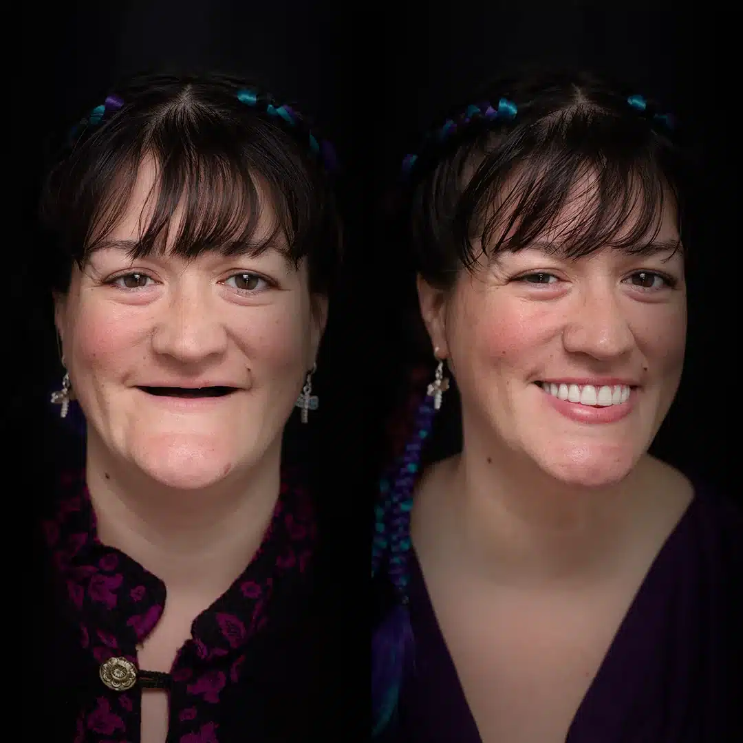 all-on-x-before-after (13)