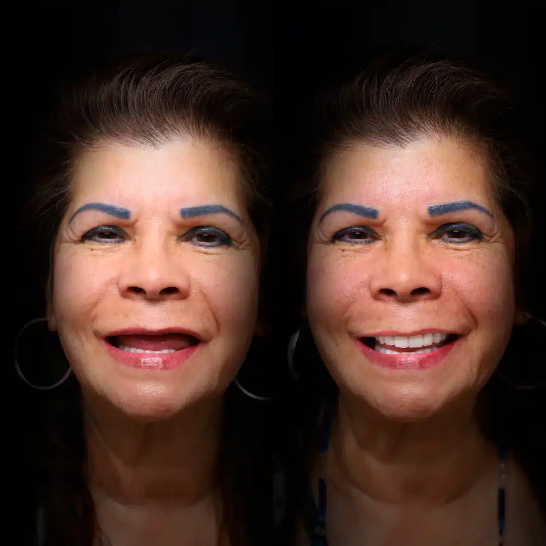 all-on-x-before-after (14)