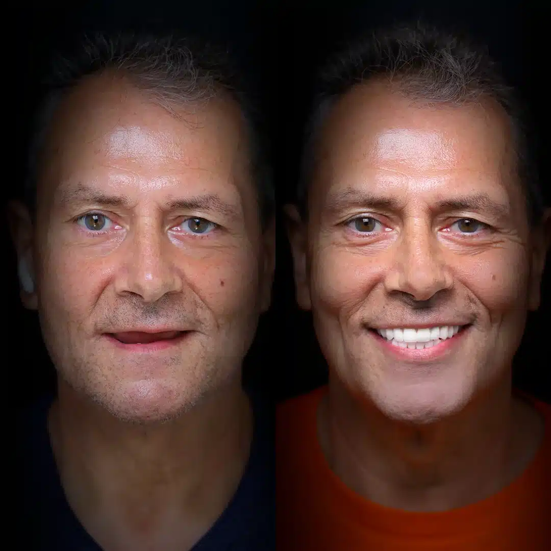 all-on-x-before-after (15)