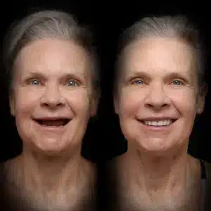 all-on-x-before-after (17)