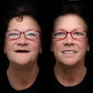 all-on-x-before-after (18)