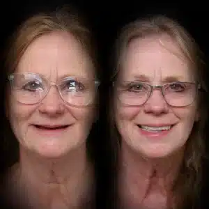 all-on-x-before-after (19)