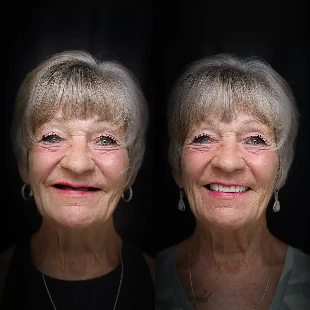 all-on-x-before-after (20)