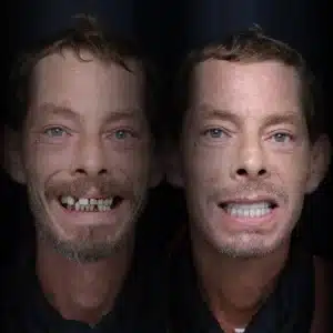 all-on-x-before-after (21)