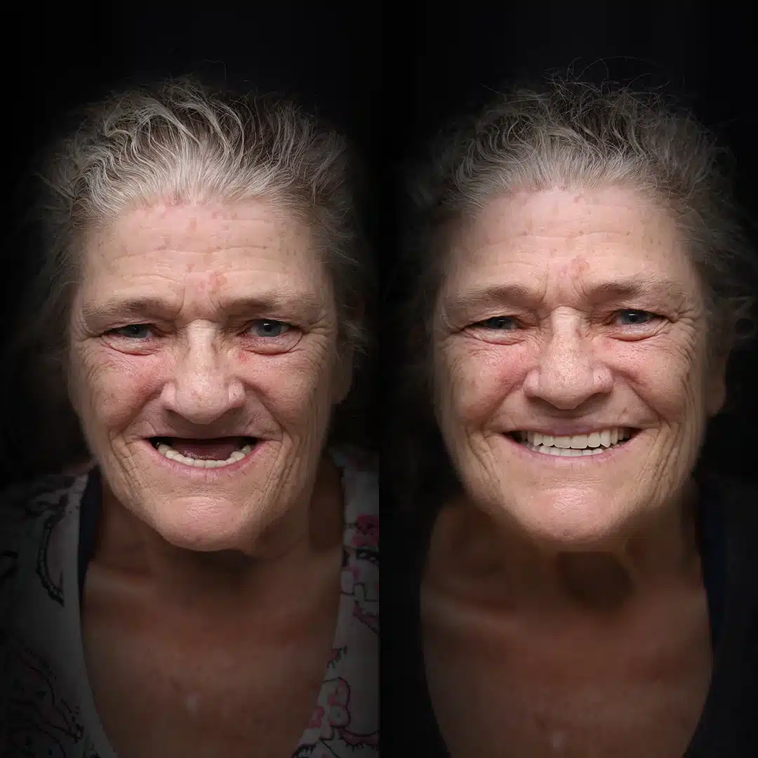 all-on-x-before-after (27)