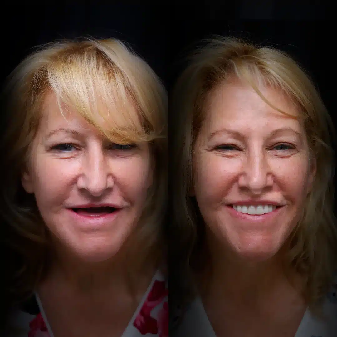 all-on-x-before-after (3)