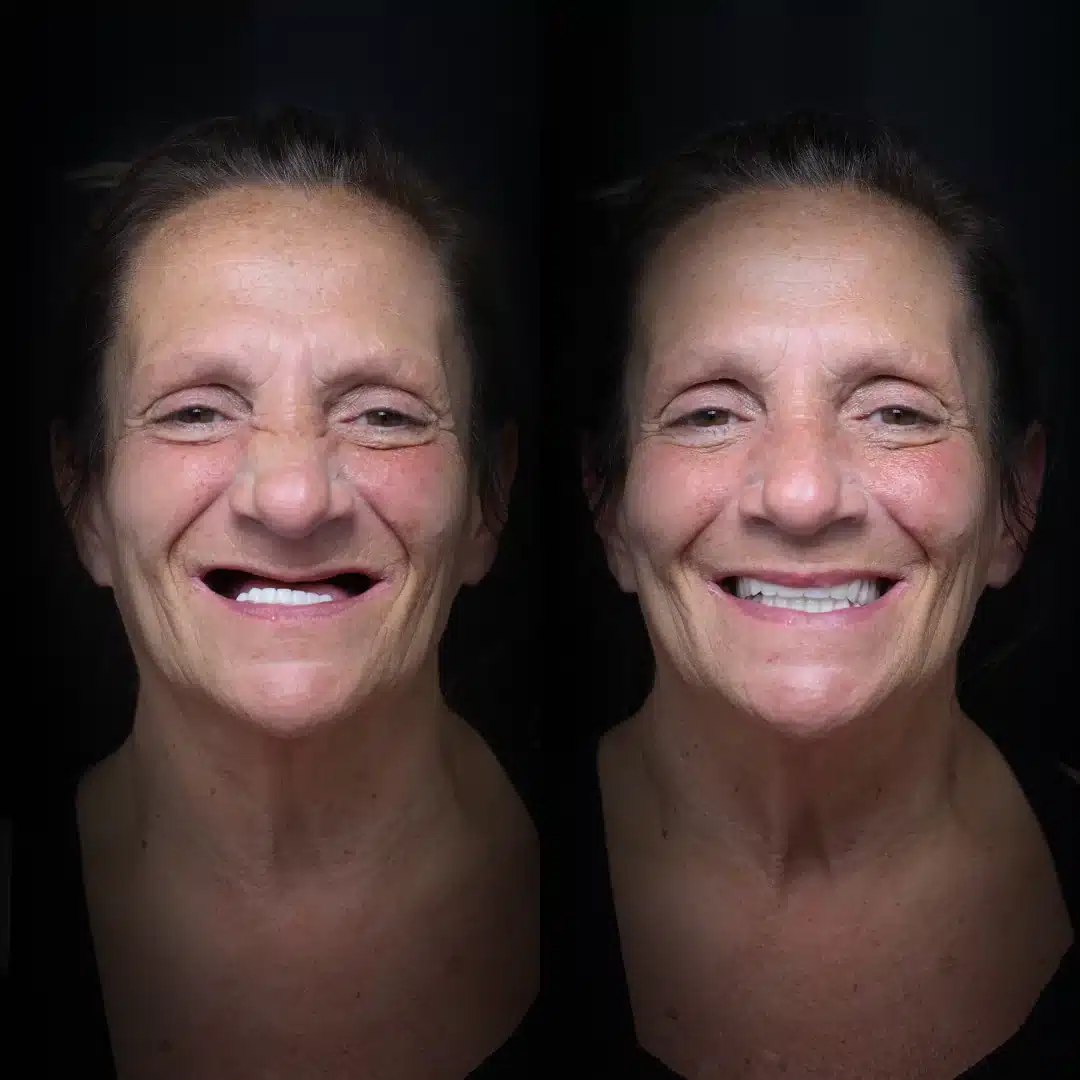all-on-x-before-after (5)