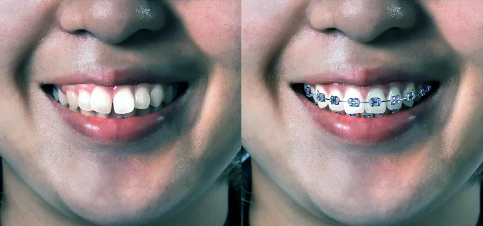 braces-before-after