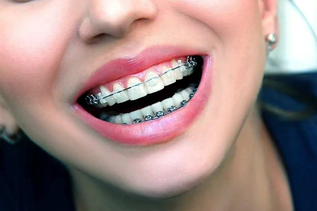 clear-braces-in-mexico