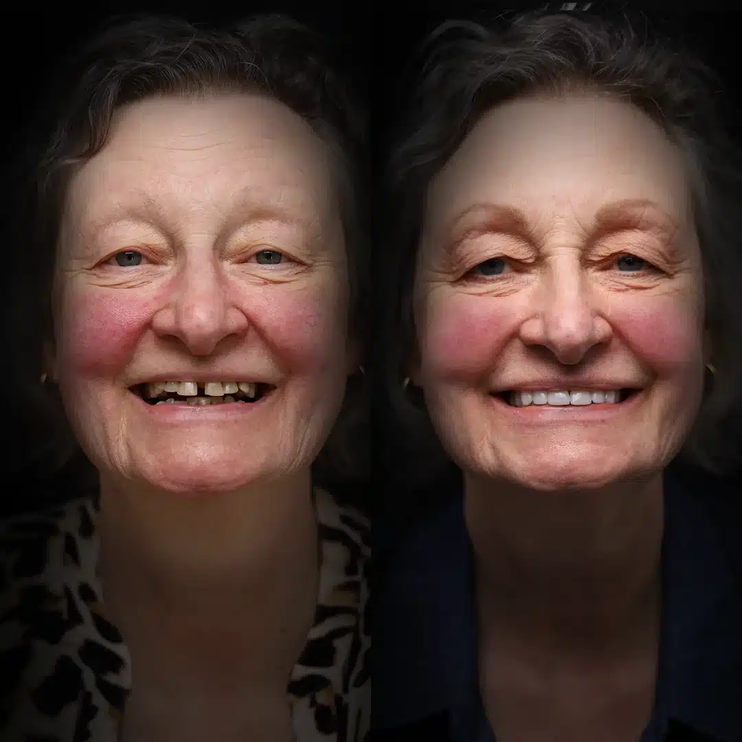 crowns-before-after (16)