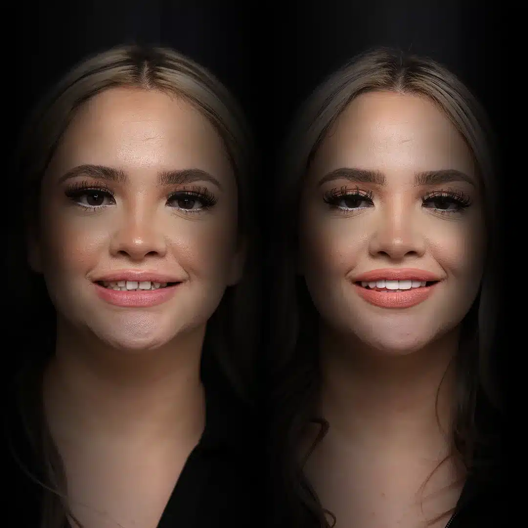 crowns-before-after (19)