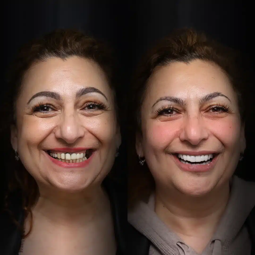 crowns-before-after (2)