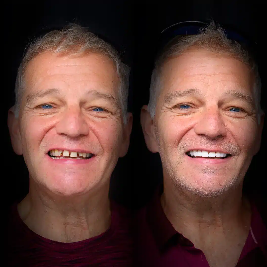 crowns-before-after (20)
