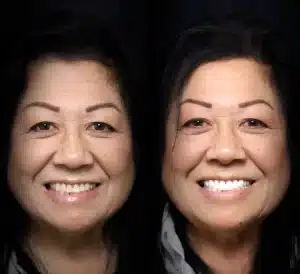 crowns-before-after (7)
