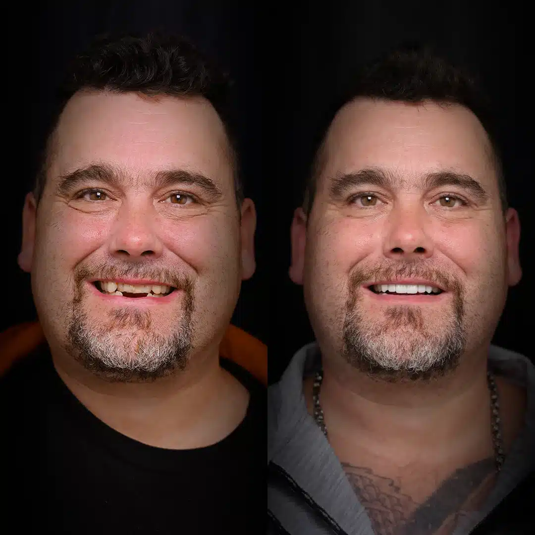 crowns-before-after (8)