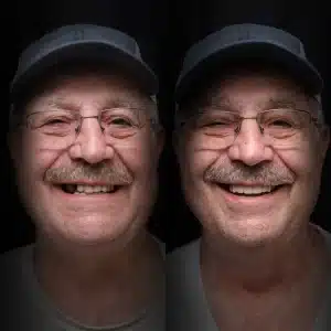 crowns-before-after (9)