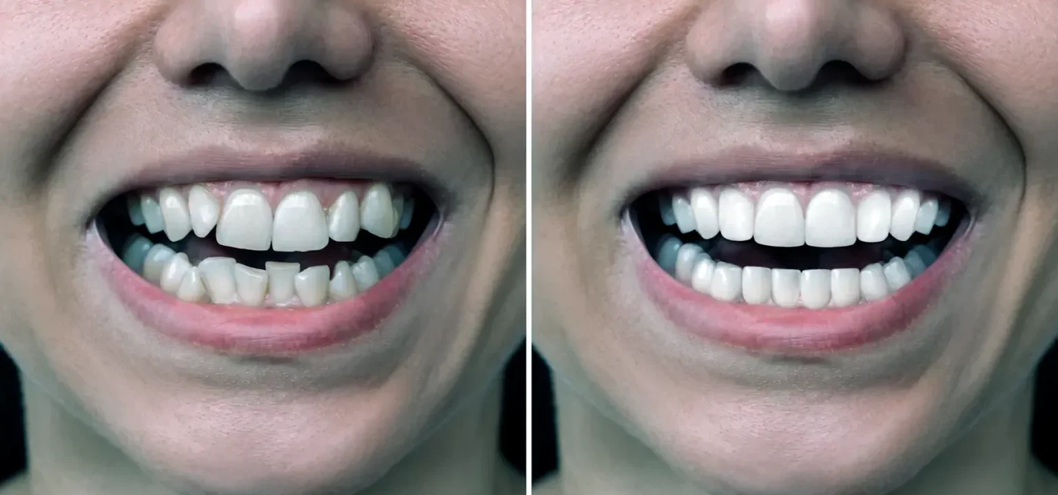 dental-braces-before-after