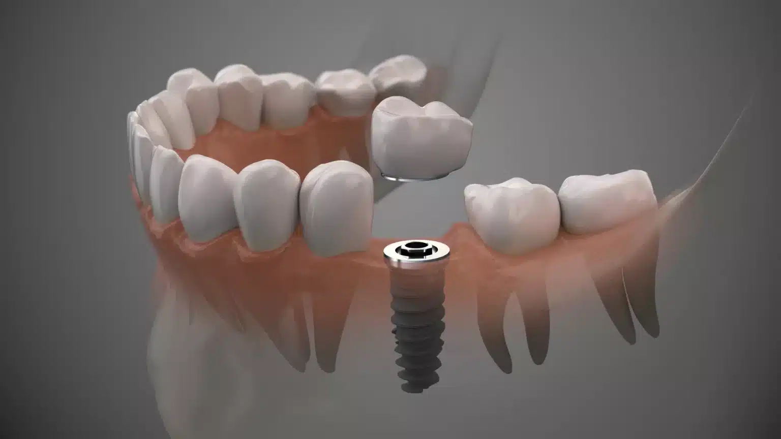 implant