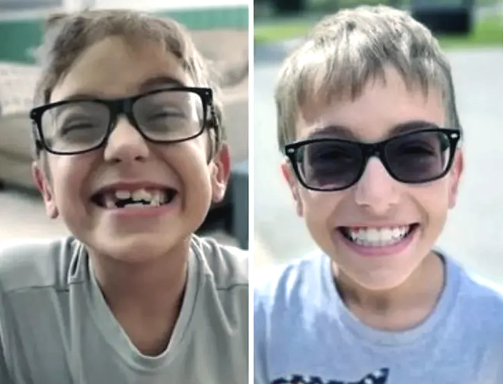 invisalign-mexico-before-after (1)