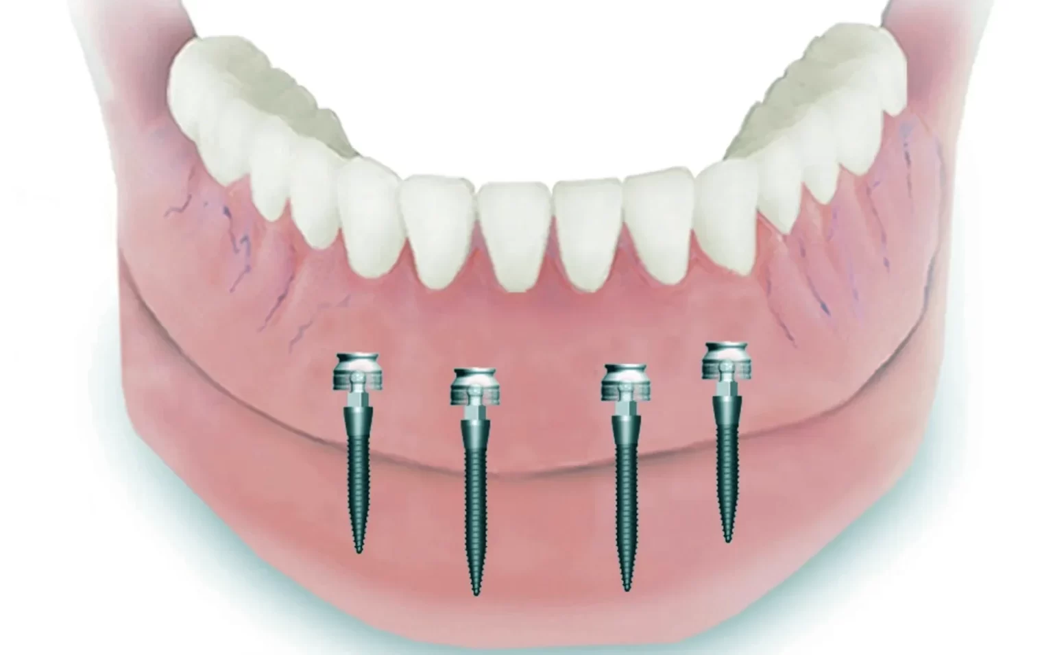 mini-dental-implants