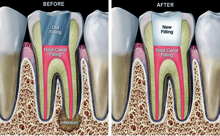 root-canal-retreatment