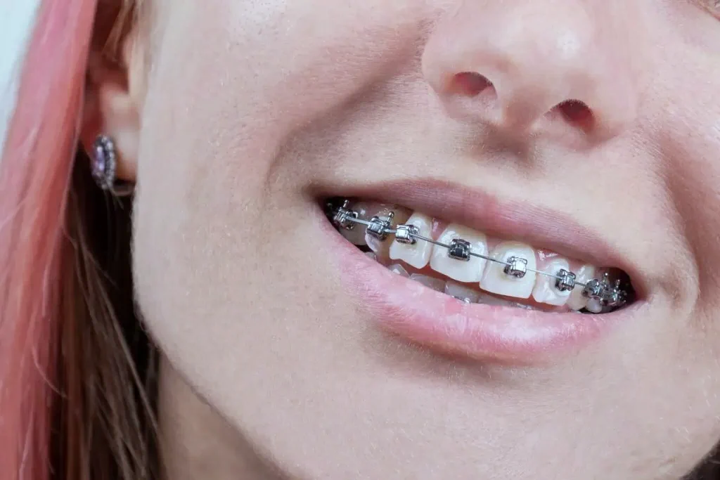 self-ligating-metalic-braces-in-mexico