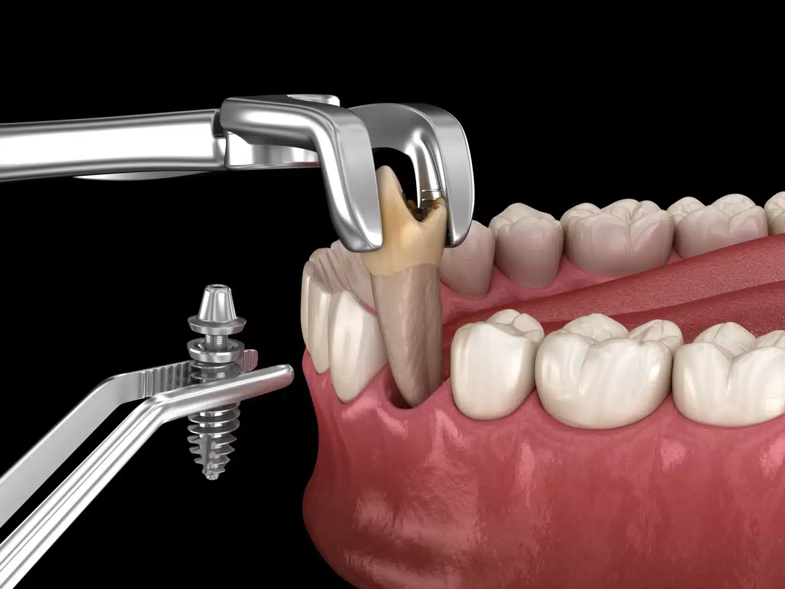 tooth-extraction