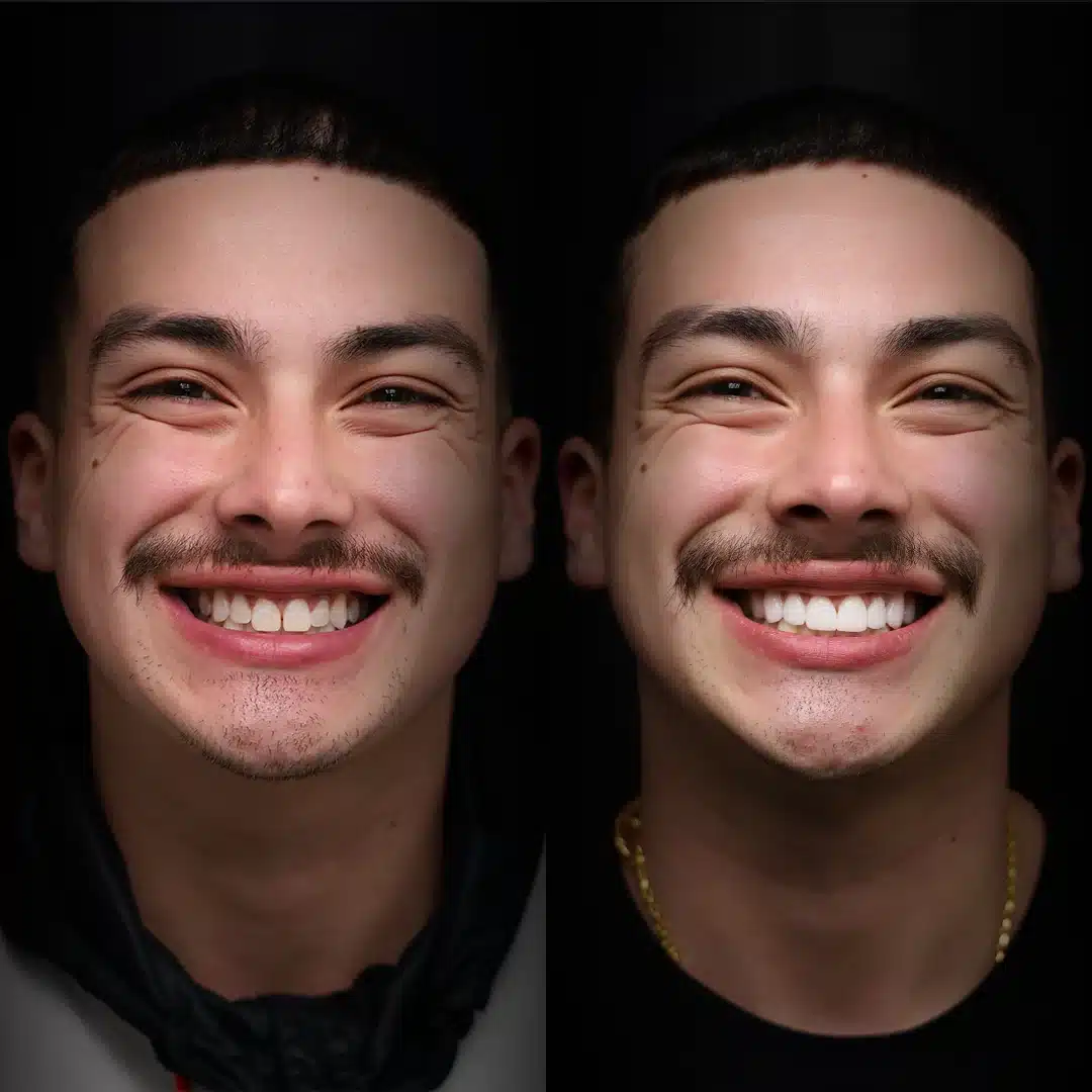 veneers-before-after (7)